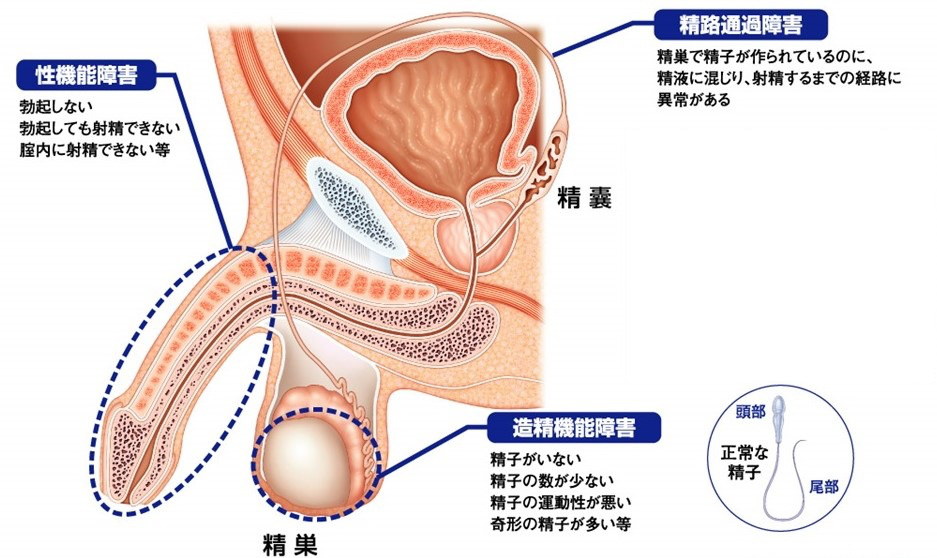 男性不妊症の原因